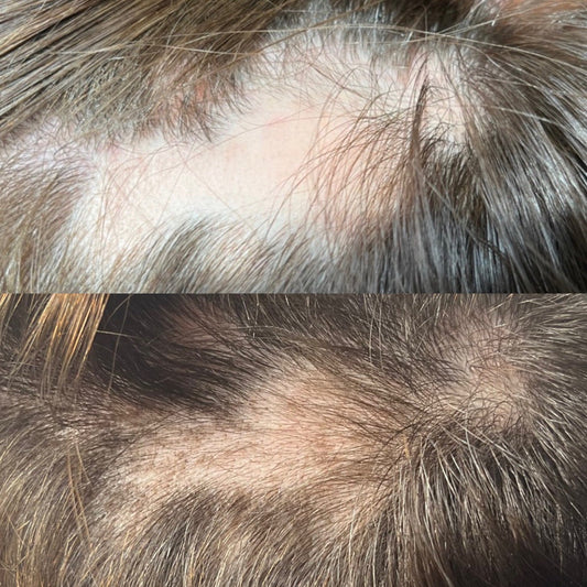 Biopsier og ardannende hårtab: Derfor er korrekt diagnose afgørende